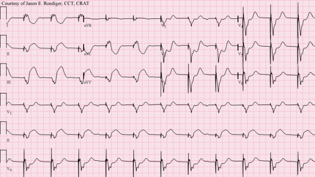 Sgarbossa Criteria Ecg Guru Instructor Resources